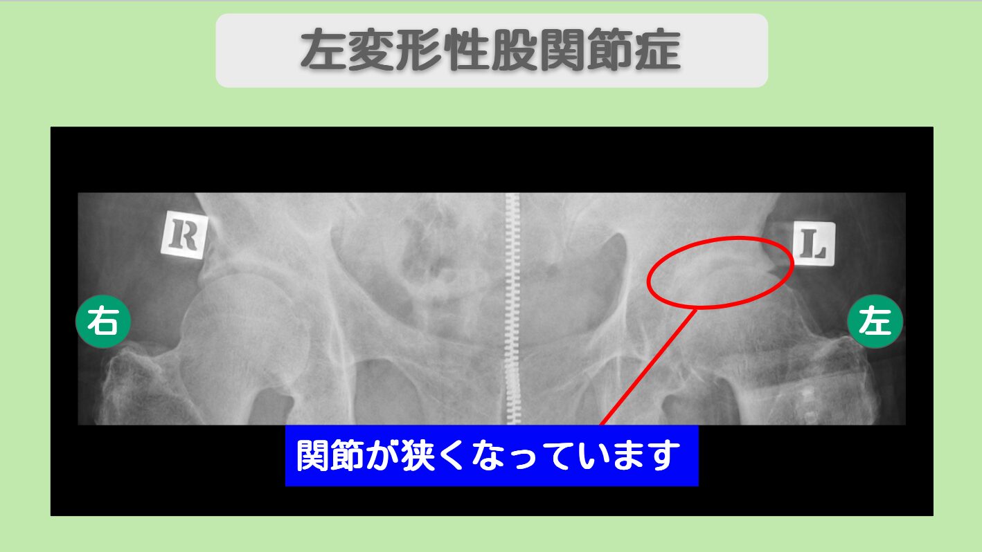 変形性股関節症