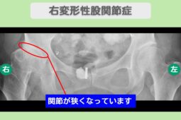 変形性股関節症
