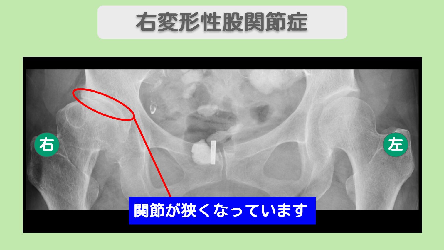 変形性股関節症