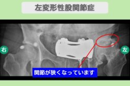変形性股関節症