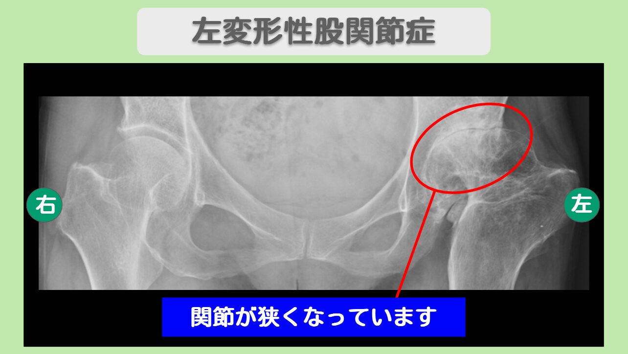 左変形性股関節症