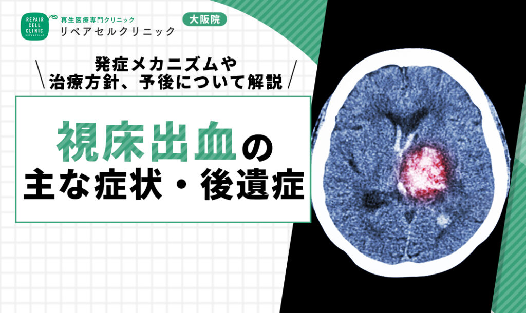 視床出血の主な症状・後遺症|発症メカニズムや治療方針、予後について解説