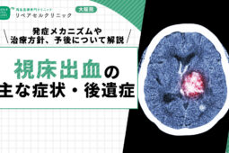 視床出血の主な症状・後遺症｜発症メカニズムや治療方針、予後について解説
