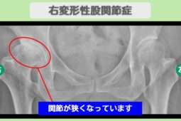 変形性股関節症