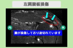 左肩腱板損傷