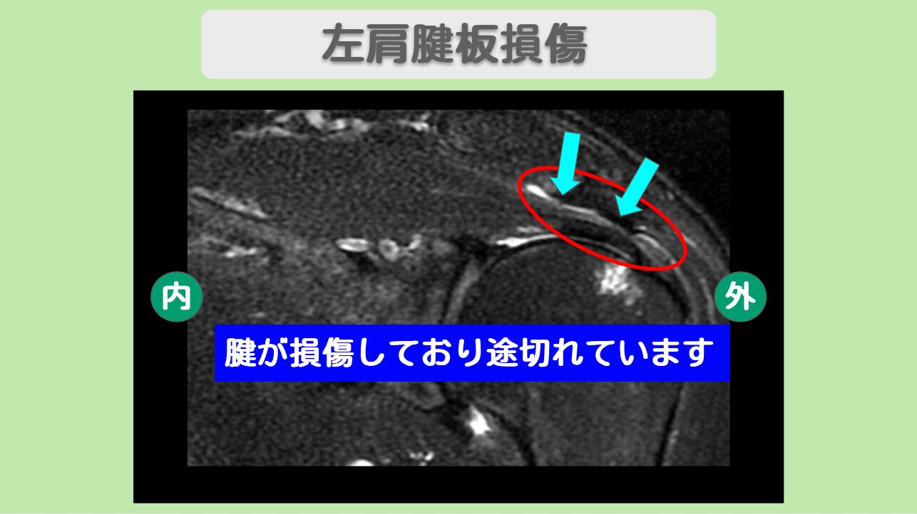 左肩腱板損傷