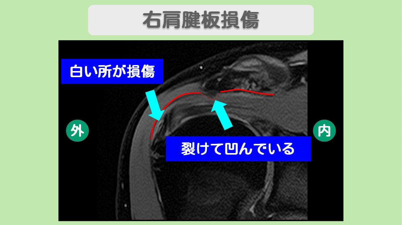 右肩腱板損傷
