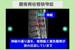 腰部脊柱管狭窄症