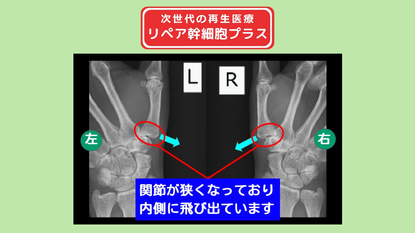 両母指CM関節症