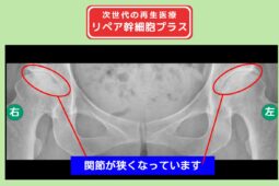 両変形性股関節症