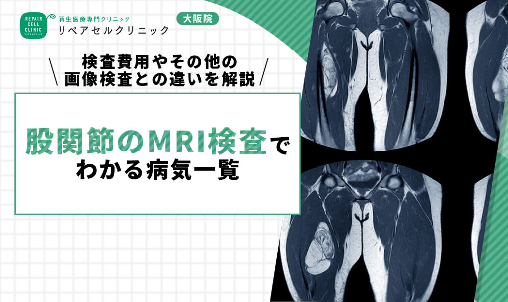股関節のMRI検査でわかる病気一覧｜検査費用やその他の画像検査との違いを解説