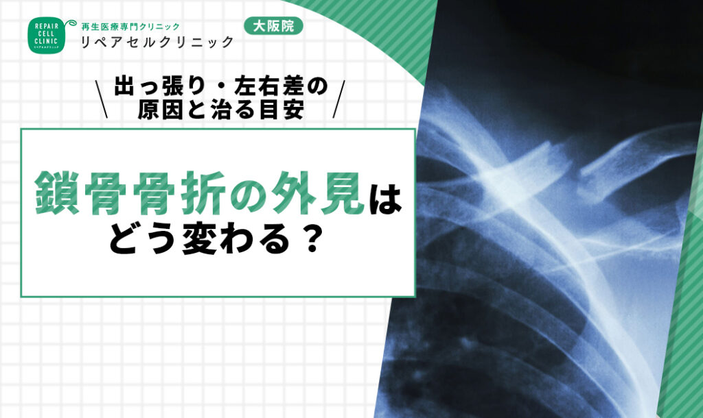 鎖骨骨折の外見はどう変わる？出っ張り・左右差の原因と治る目安を紹介