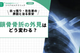 鎖骨骨折の外見はどう変わる？出っ張り・左右差の原因と治る目安を紹介