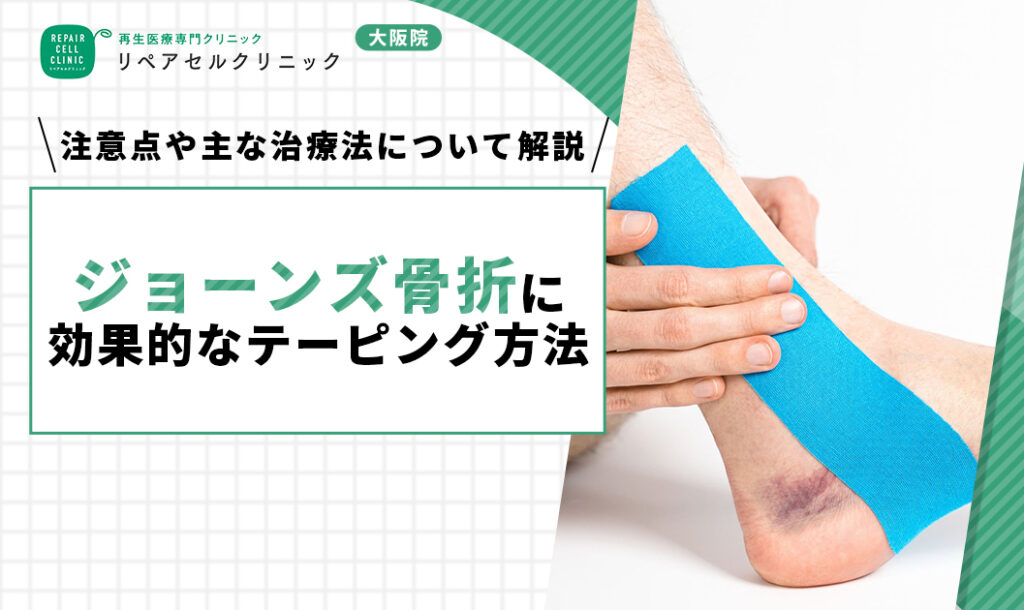 ジョーンズ骨折に効果的なテーピング方法｜注意点や主な治療法について解説