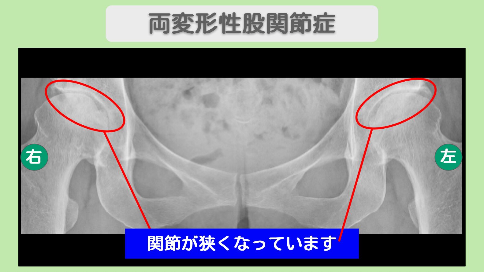 両変形性股関節症