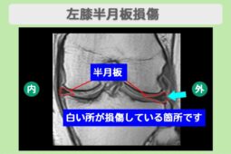 半月板損傷