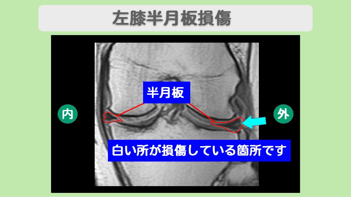 半月板損傷