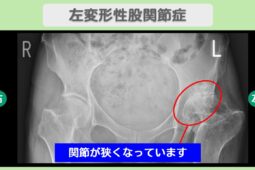 左変形性股関節症