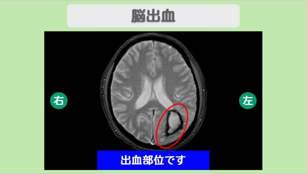 脳出血MRI