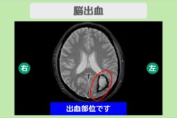 脳出血MRI