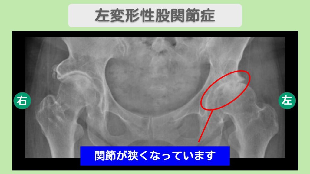 左変形性股関節症