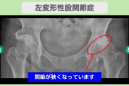 左変形性股関節症