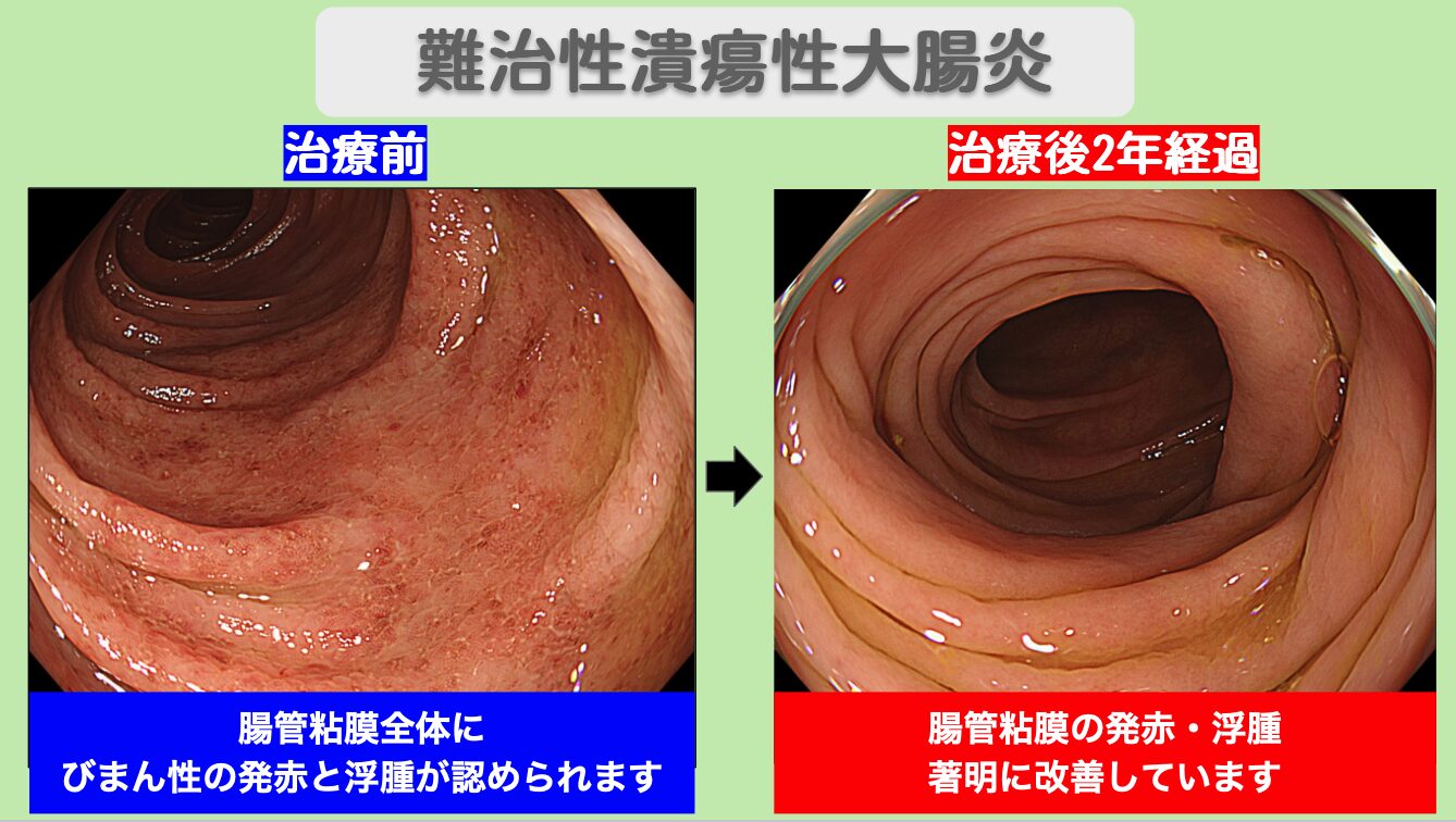 難治性潰瘍性大腸炎