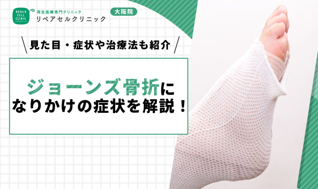 ジョーンズ骨折になりかけの症状を解説！見た目・症状や治療法も紹介