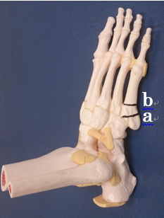 「b」の領域（ジョーンズ骨折）の痛み