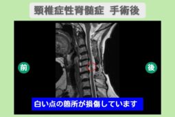 頚椎性脊髄症