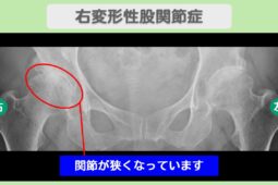 右変形性股関節症