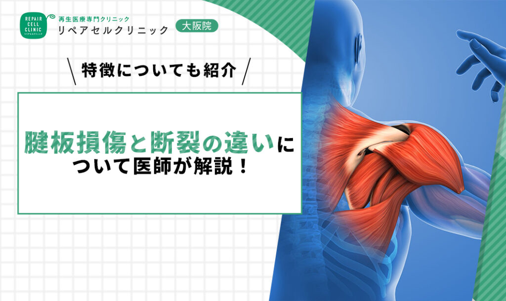 腱板損傷と断裂の違いについて医師が解説！特徴についても紹介