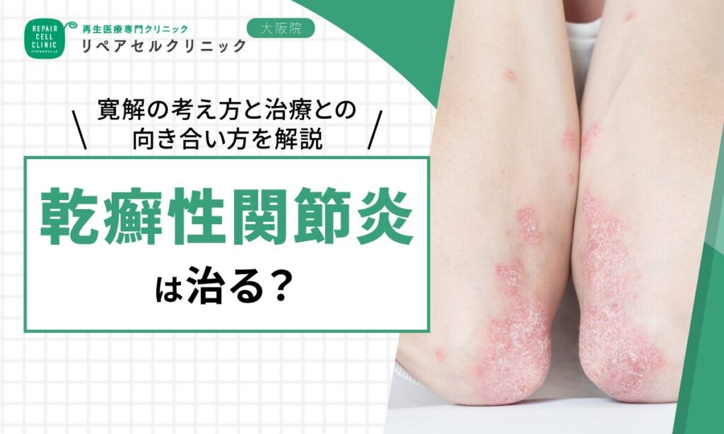 乾癬性関節炎は治ったと言える?症状が落ち着くケースと再発を防ぐ考え方