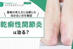 乾癬性関節炎は治ったと言える?症状が落ち着くケースと再発を防ぐ考え方