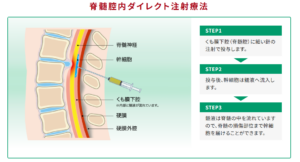 脊髄腔内ダイレクト注射療法