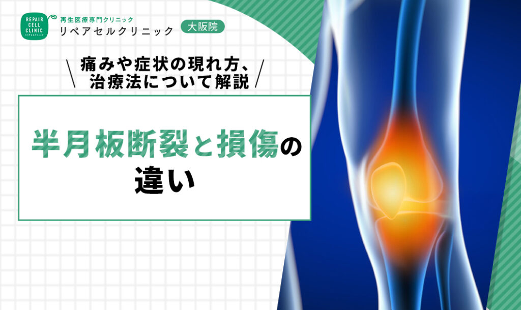 半月板断裂と損傷の違い｜痛みや症状の現れ方、治療法について解説【医師監修】