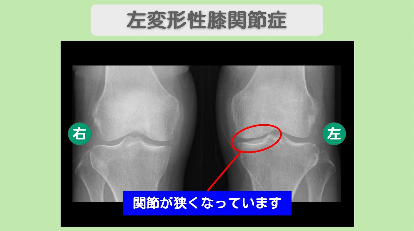 “リペア幹細胞” 右膝痛み4が0に完全消失！快適な歩行を取り戻した！両膝変形性関節症 70代 女性