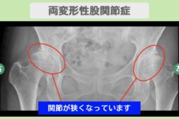 両変形性股関節症