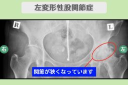 左変形性股関節症