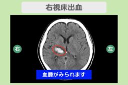 右視床出血