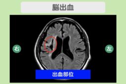 脳出血
