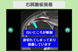 右肩腱板損傷