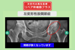 左変形性股関節症