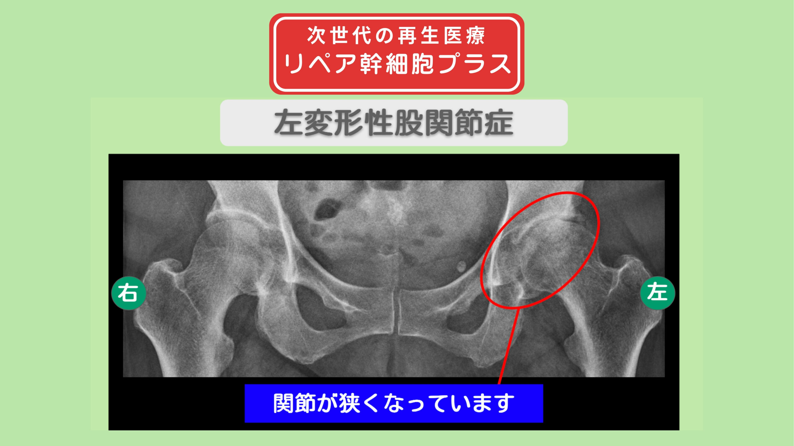 左変形性股関節症