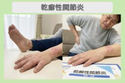 乾癬性関節炎