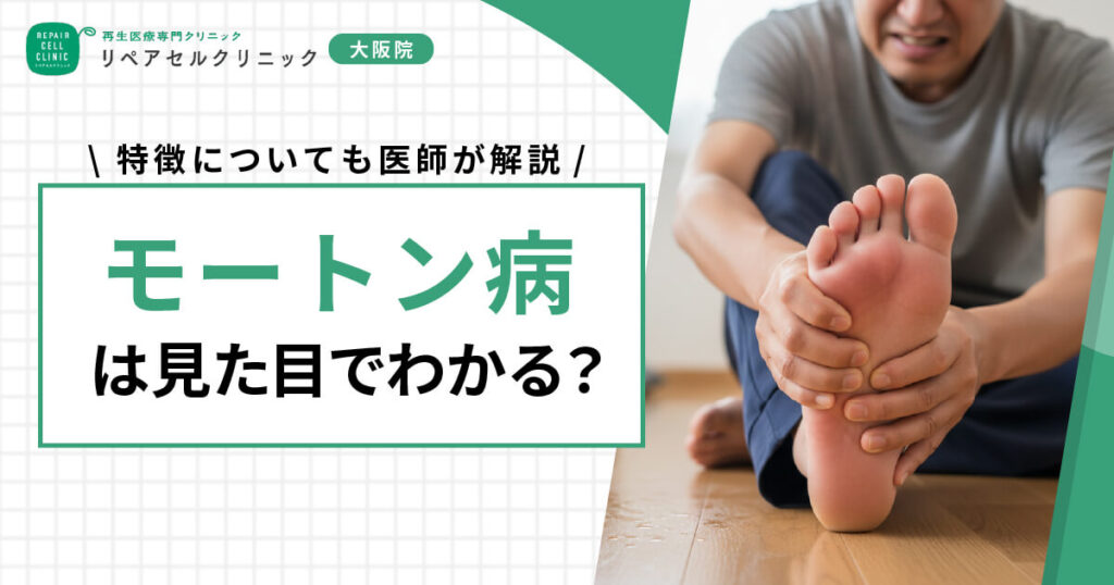 モートン病は見た目でわかる?特徴についても医師が解説
