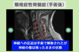 頚椎症性脊髄症（手術後）