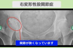 右変形性股関節症
