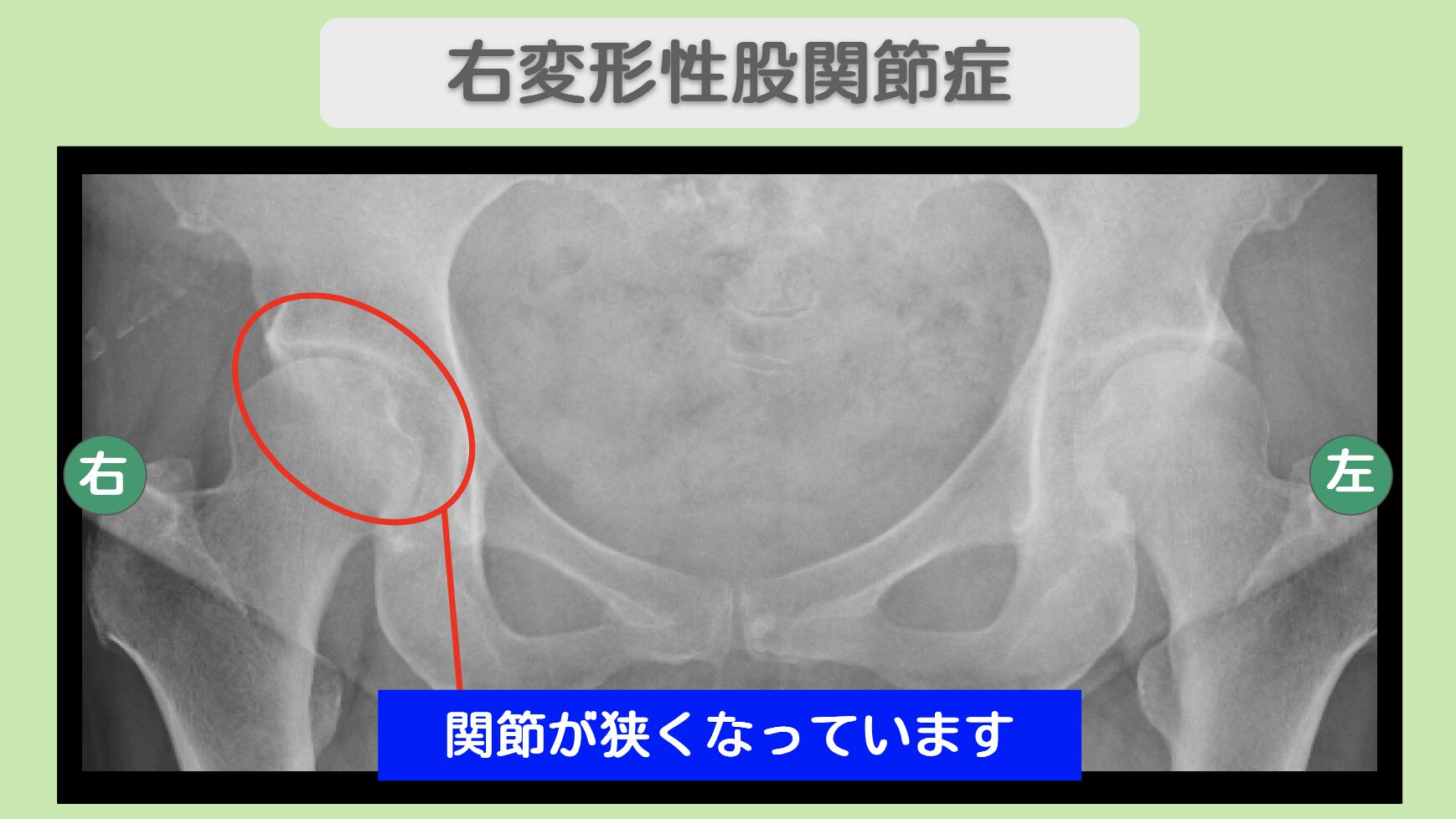 右変形性股関節症