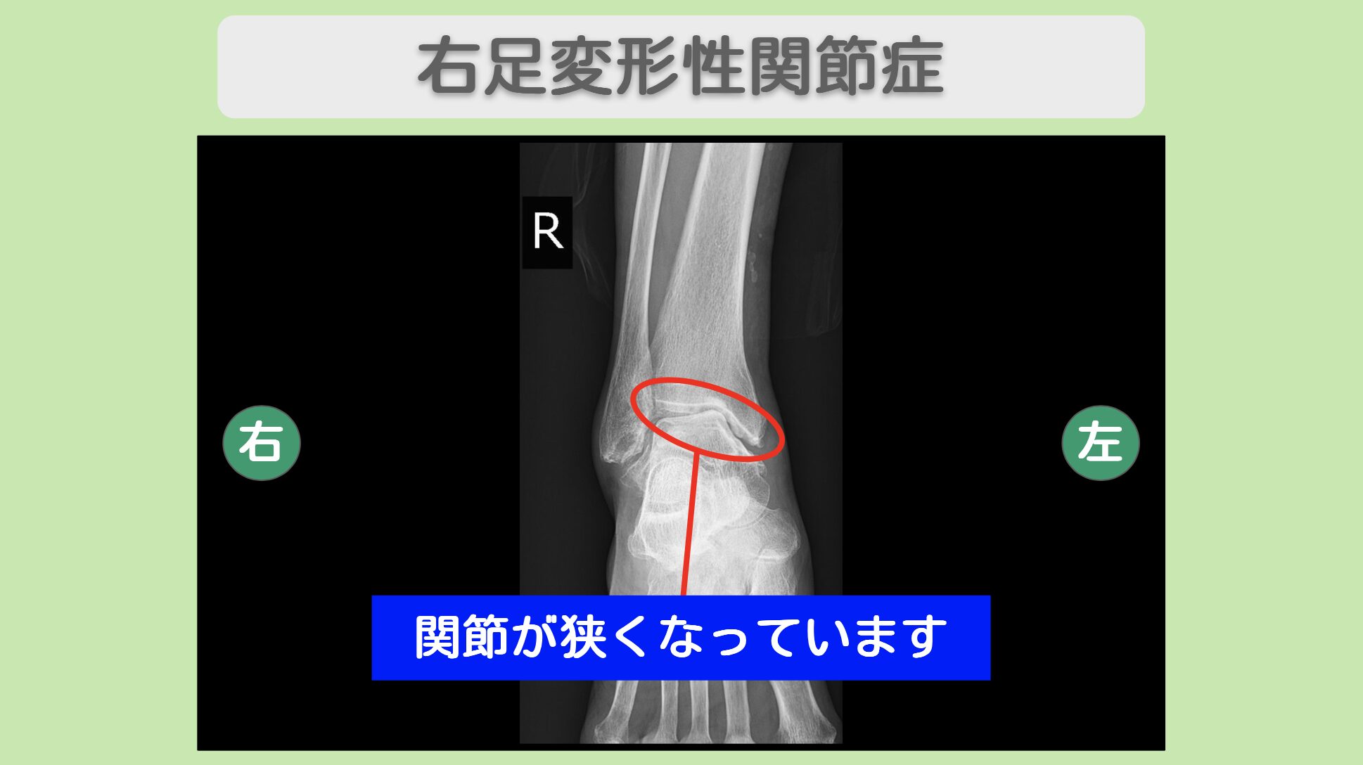 右膝変形性関節症